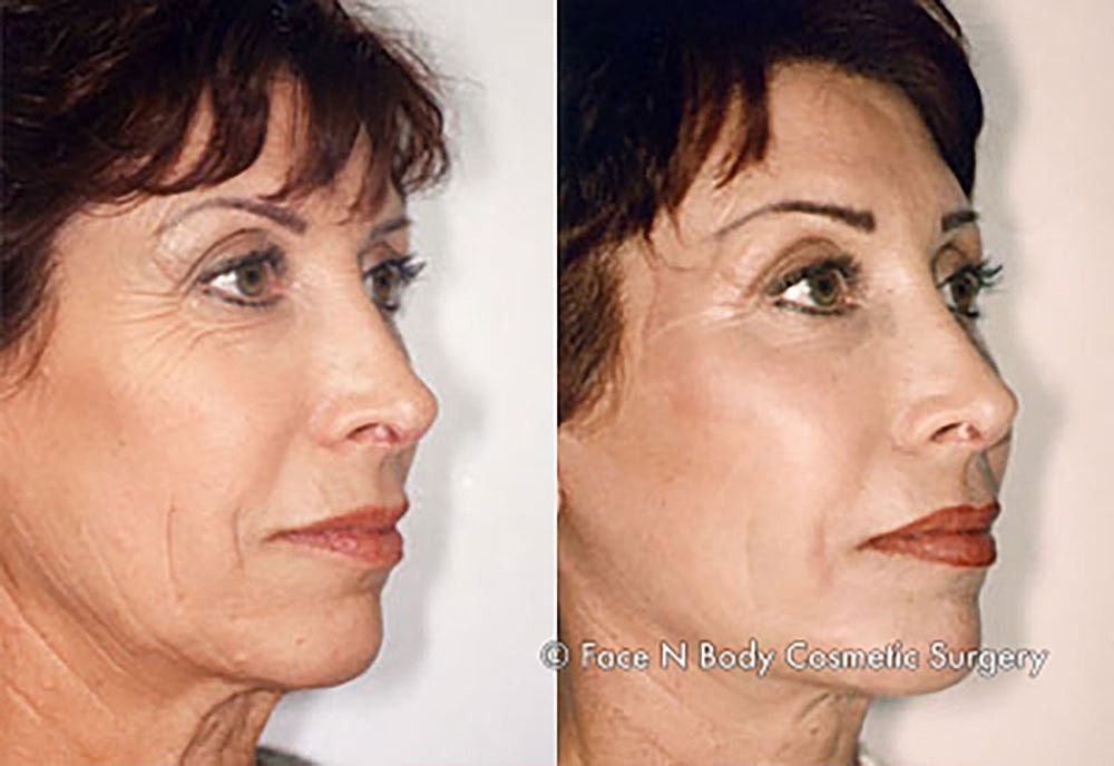 Chemical Peels Before & After