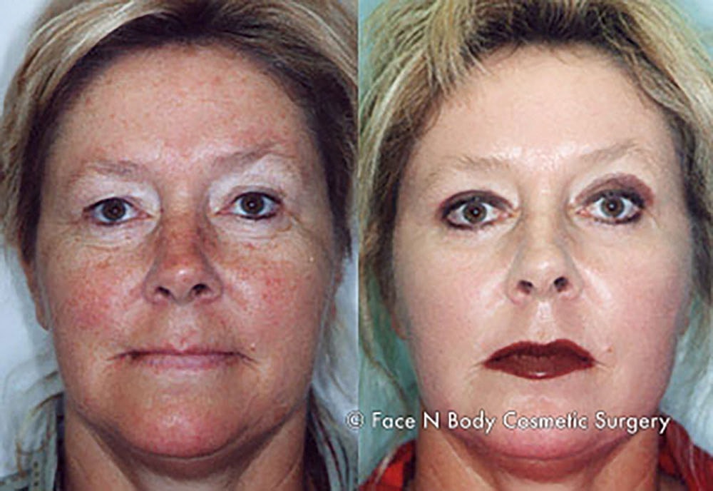 Chemical Peels Before & After