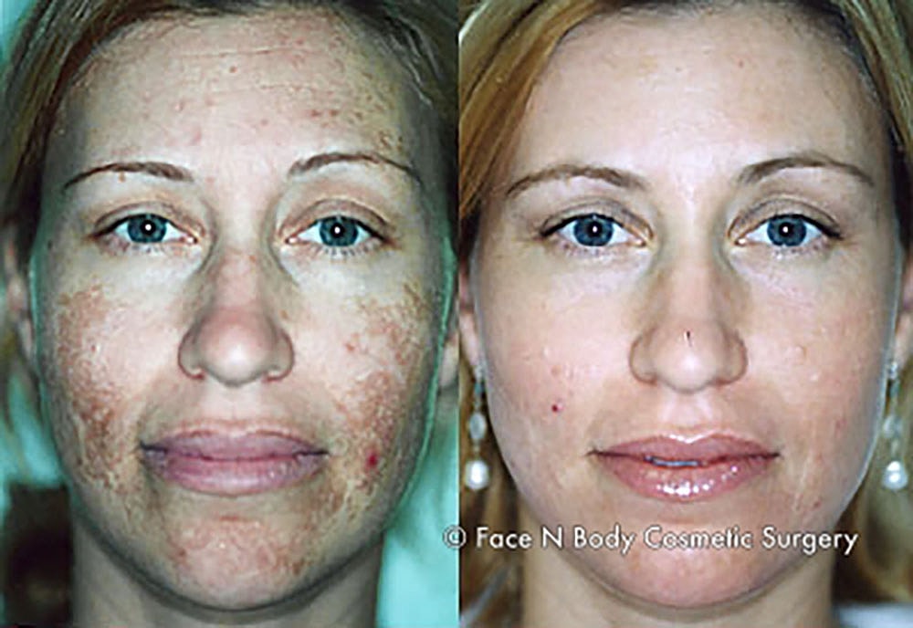 Chemical Peels Before & After