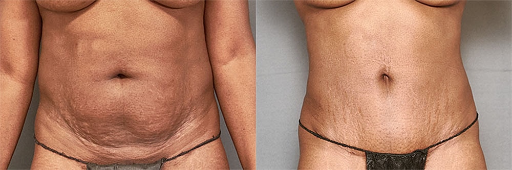 Contoured Abdominoplasty Before & After