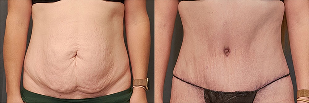 Contoured Abdominoplasty Before & After