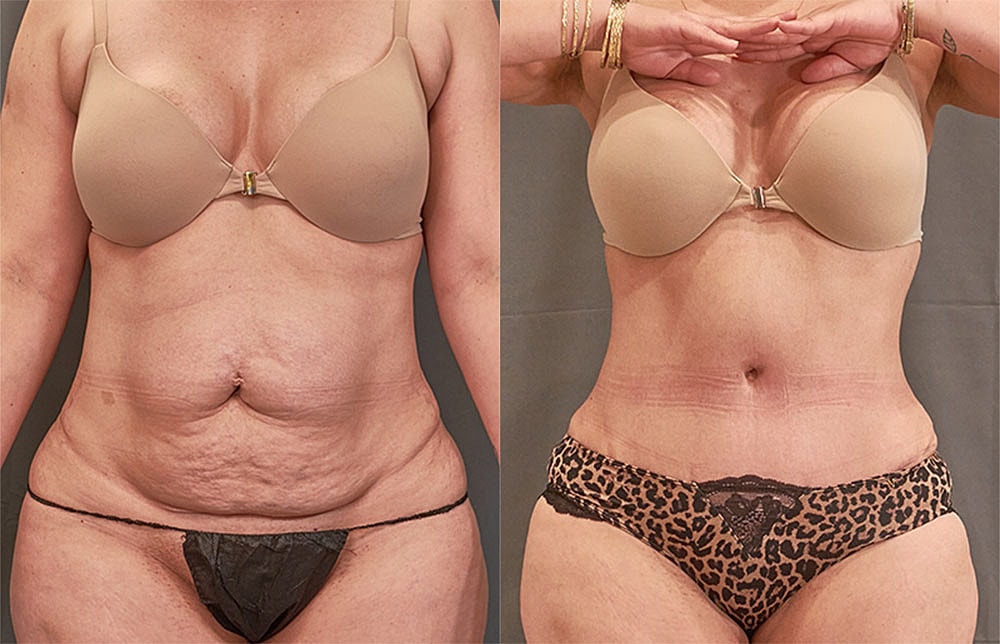 Contoured Abdominoplasty Before & After