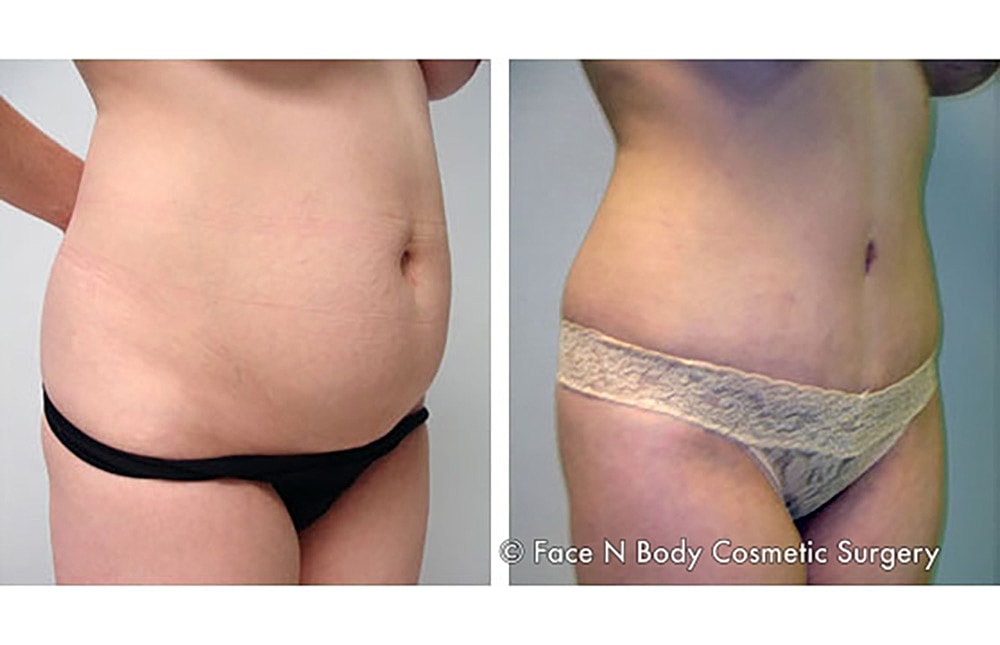 Contoured Abdominoplasty Before & After