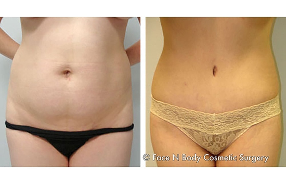 Contoured Abdominoplasty Before & After