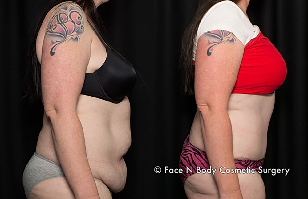 Contoured Abdominoplasty Before & After