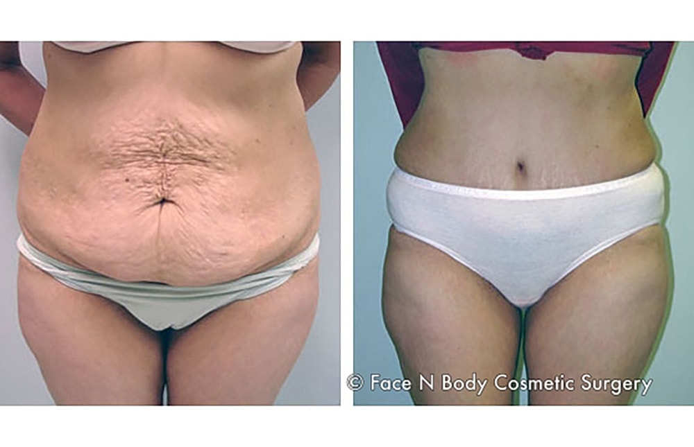 Contoured Abdominoplasty Before & After