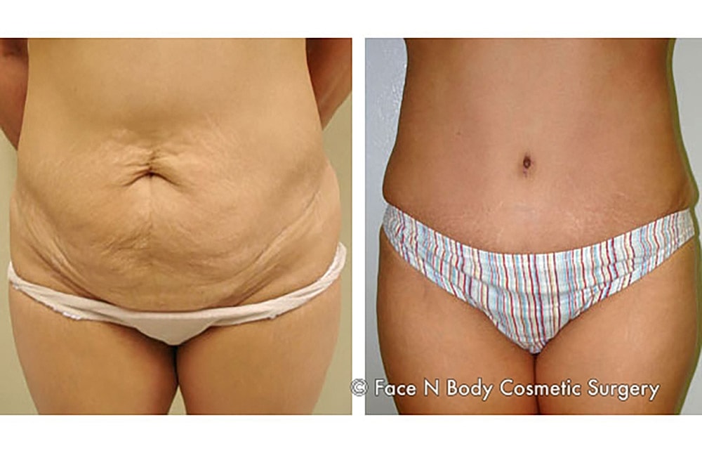 Contoured Abdominoplasty Before & After