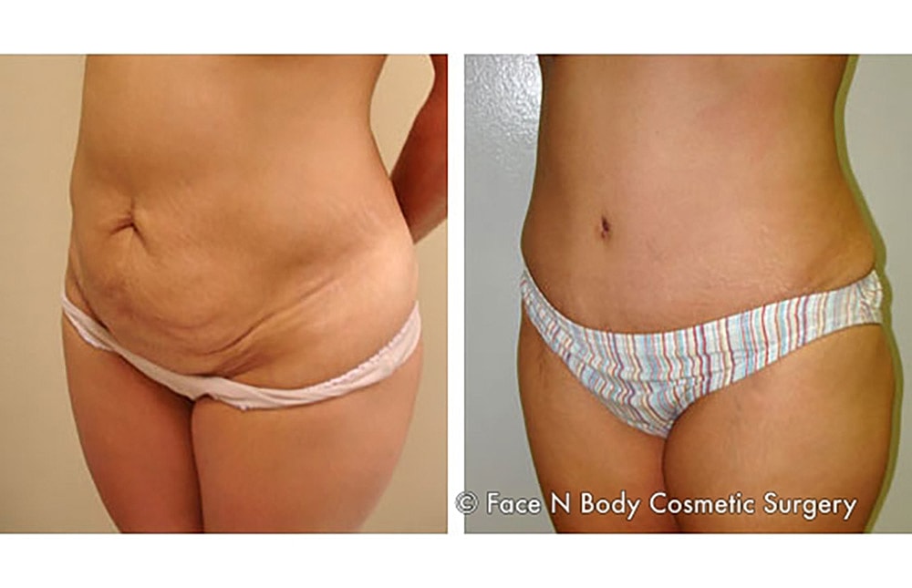 Contoured Abdominoplasty Before & After