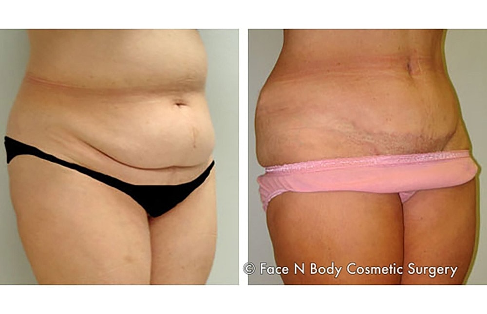 Contoured Abdominoplasty Before & After