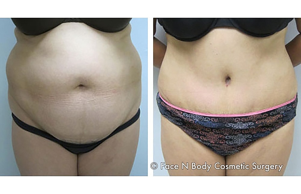 Contoured Abdominoplasty Before & After