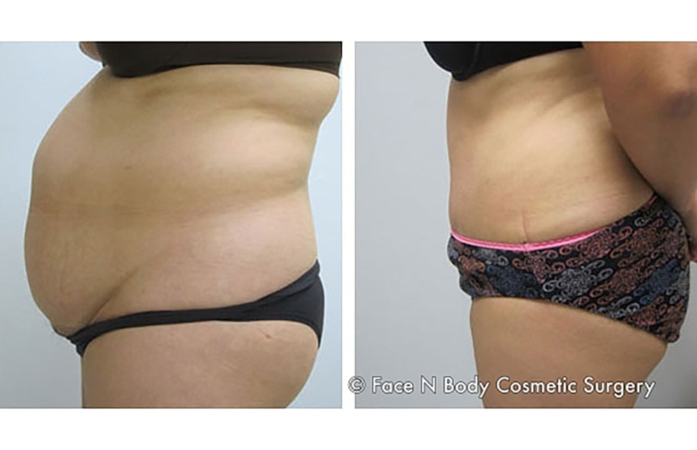 Contoured Abdominoplasty Before & After