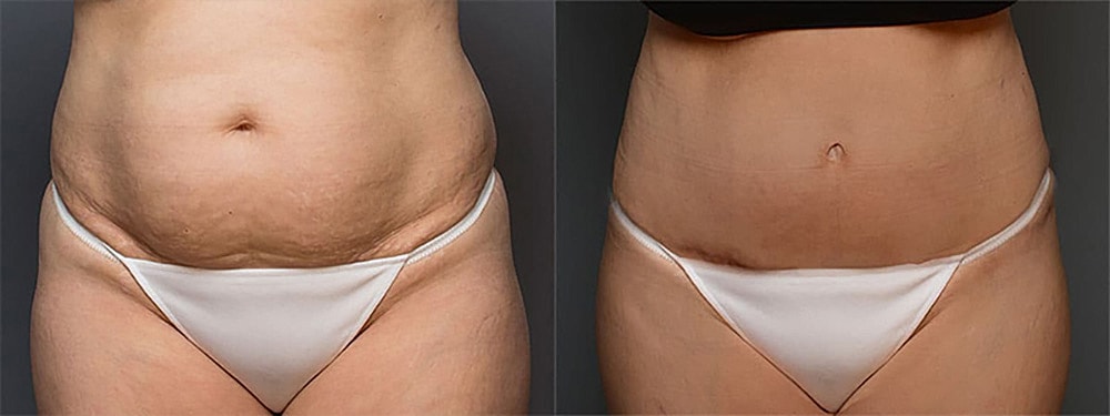 Contoured Abdominoplasty Before & After
