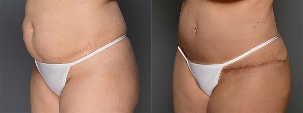 Contoured Abdominoplasty Before & After