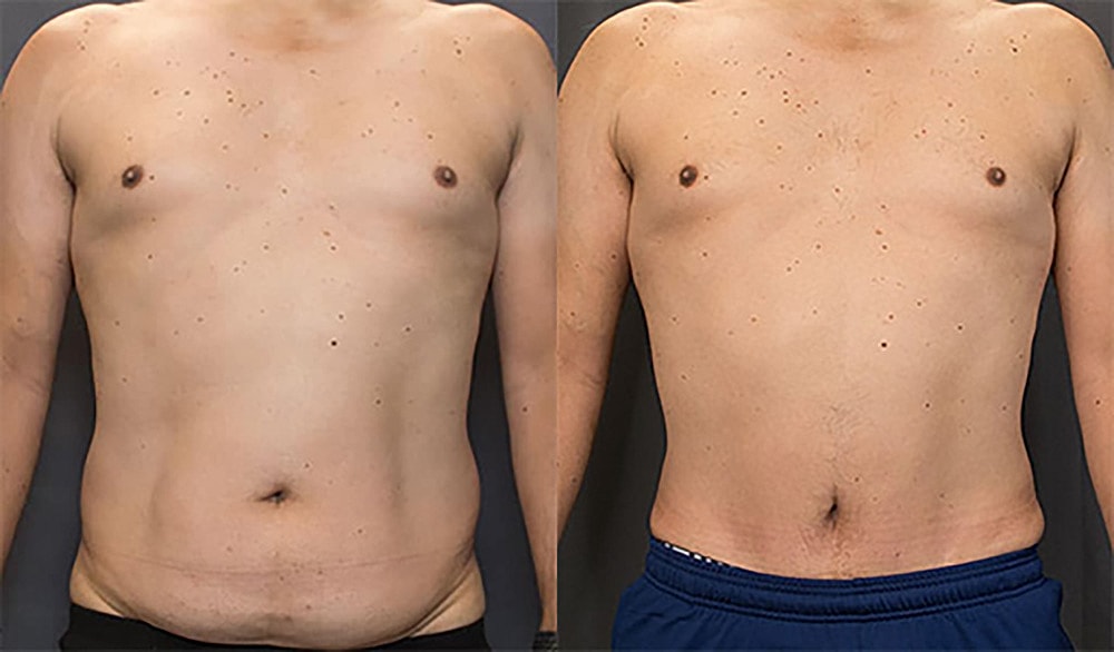 Contoured Abdominoplasty Before & After