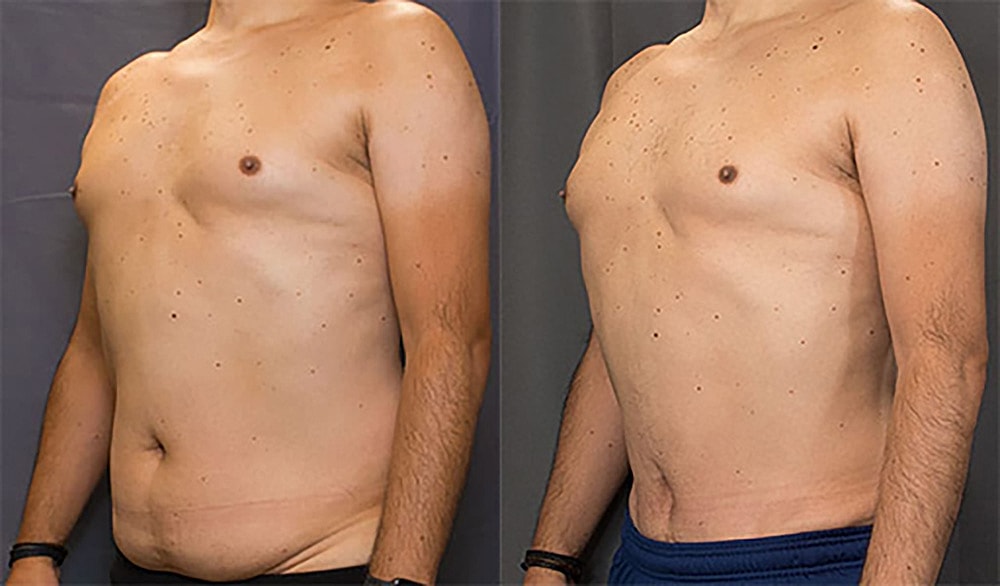 Contoured Abdominoplasty Before & After