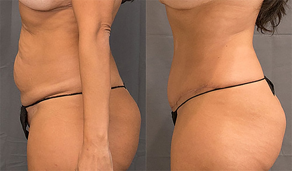Contoured Abdominoplasty Before & After