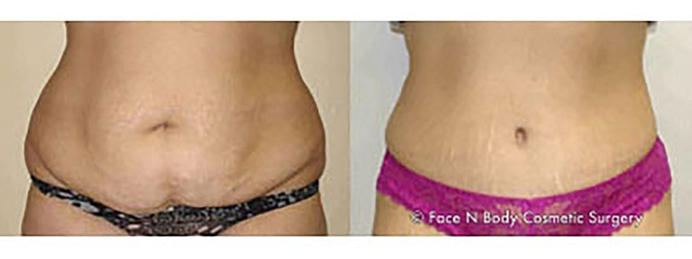 Contoured Abdominoplasty Before & After