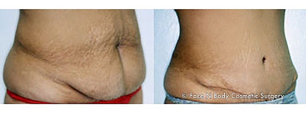 Contoured Abdominoplasty Before & After