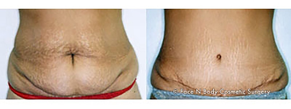 Contoured Abdominoplasty Before & After