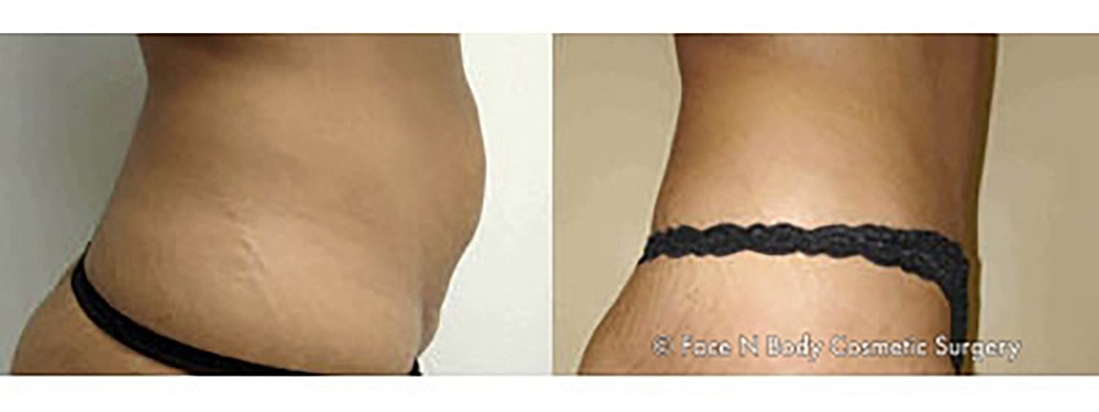 Contoured Abdominoplasty Before & After