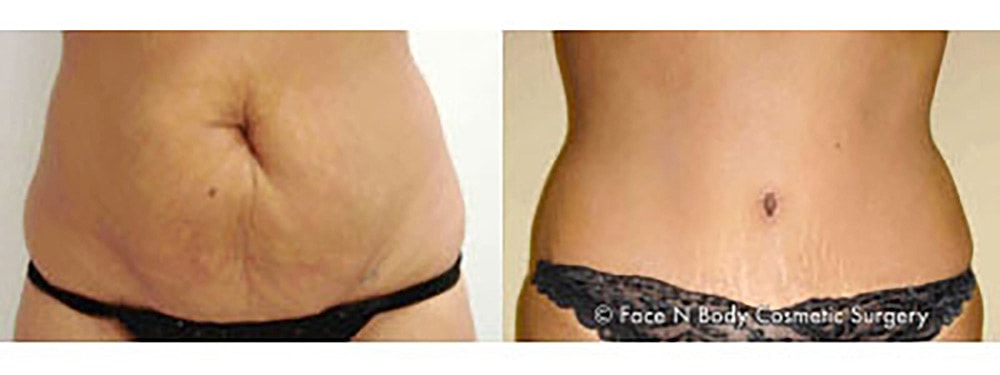 Contoured Abdominoplasty Before & After
