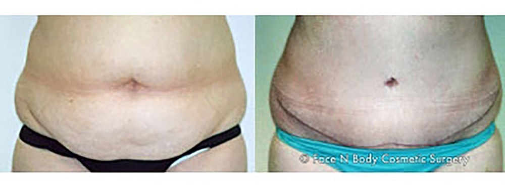 Contoured Abdominoplasty Before & After