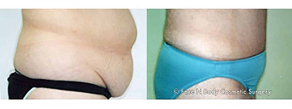 Contoured Abdominoplasty Before & After