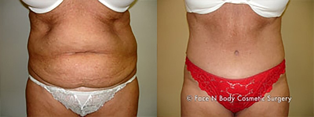 Contoured Abdominoplasty Before & After