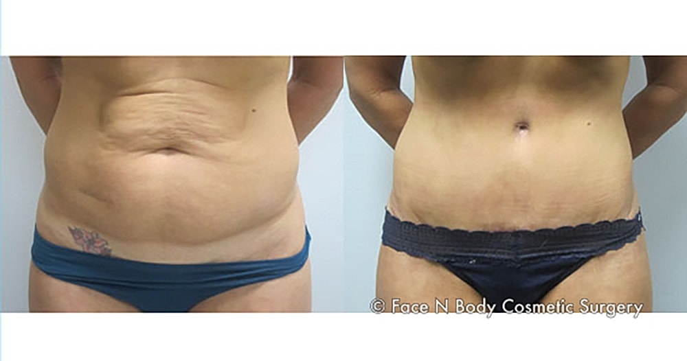 Contoured Abdominoplasty Before & After