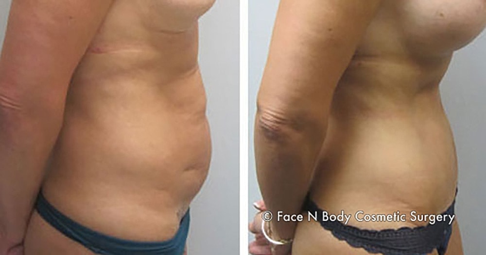 Contoured Abdominoplasty Before & After