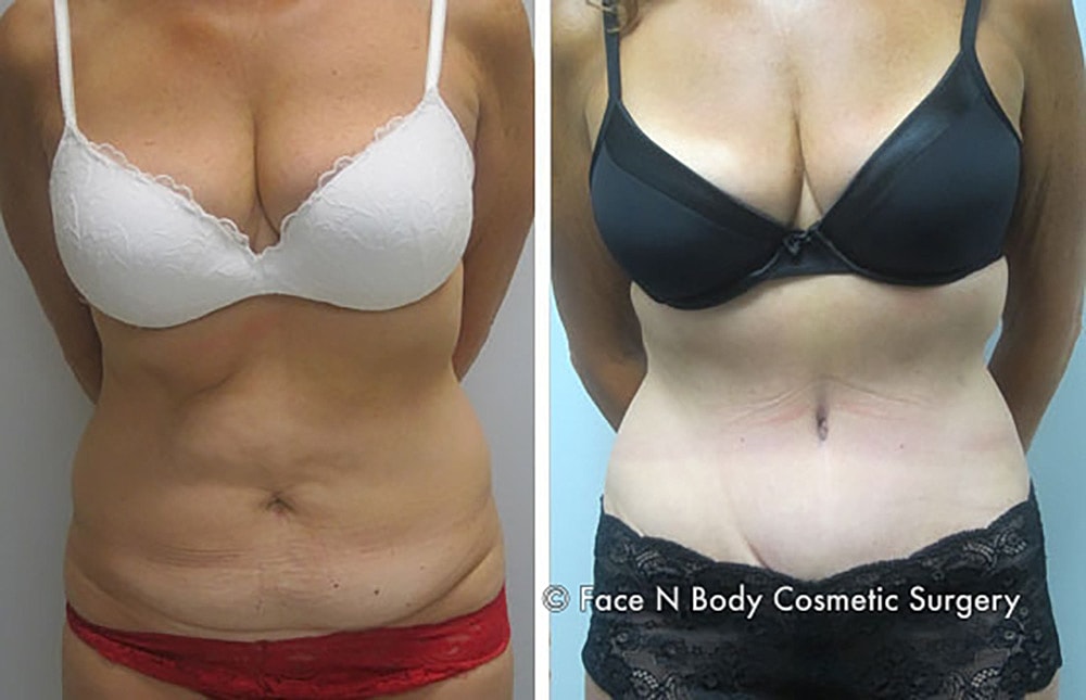 Contoured Abdominoplasty Before & After