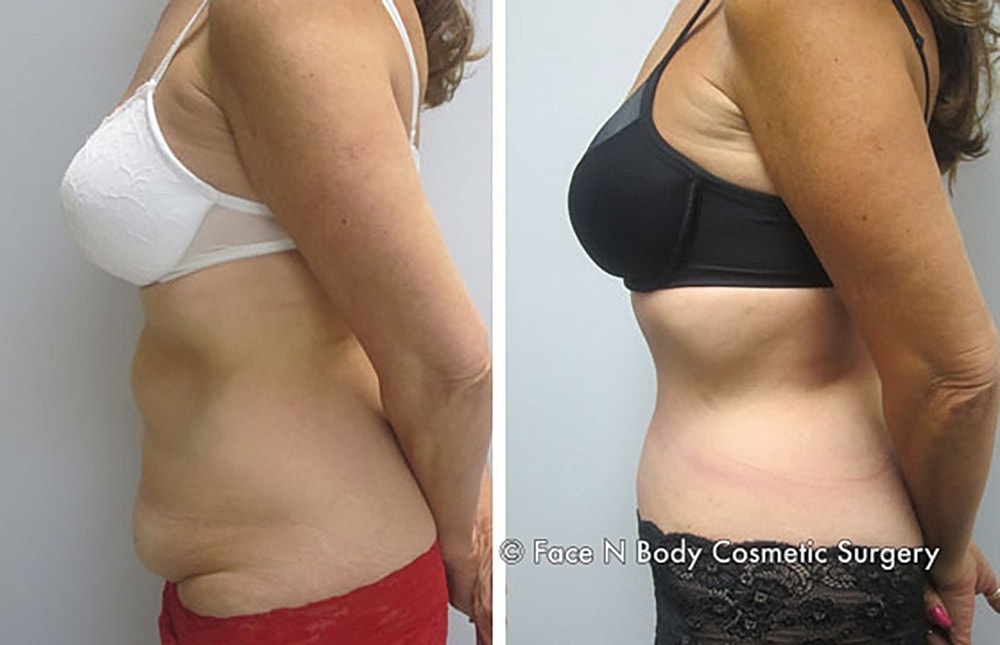 Contoured Abdominoplasty Before & After