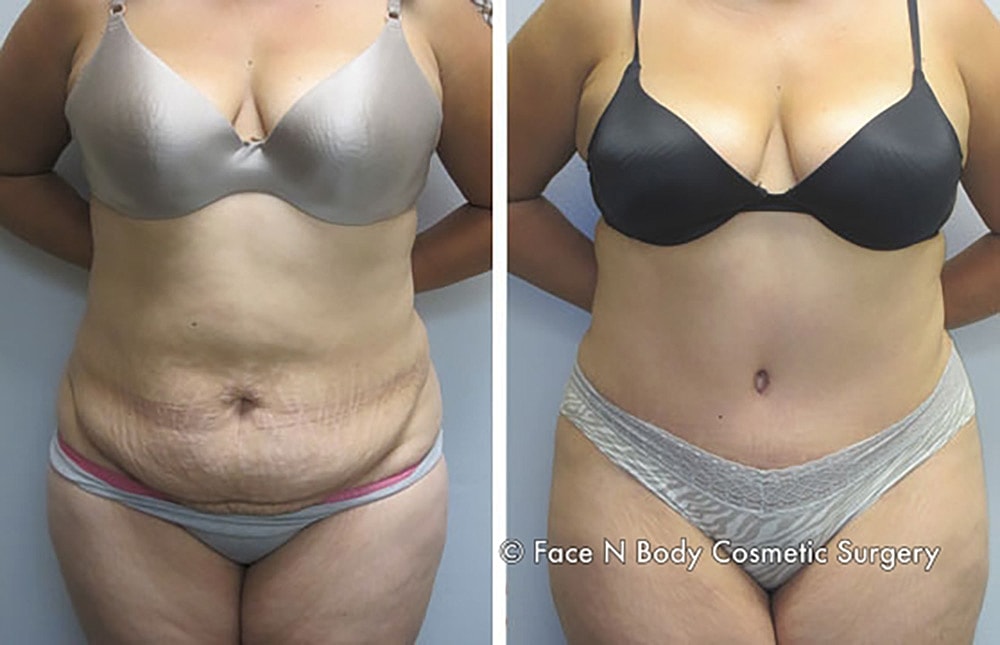 Contoured Abdominoplasty Before & After