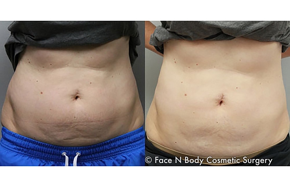 Contoured Abdominoplasty Before & After