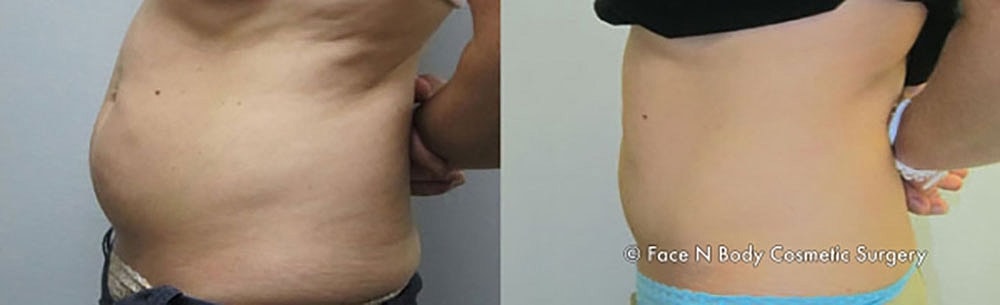 Coolsculpting Before & After