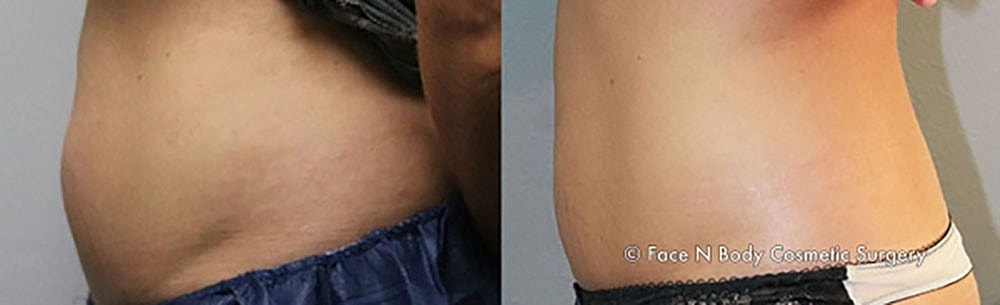 Coolsculpting Before & After
