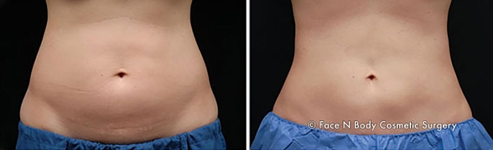 Coolsculpting Before & After