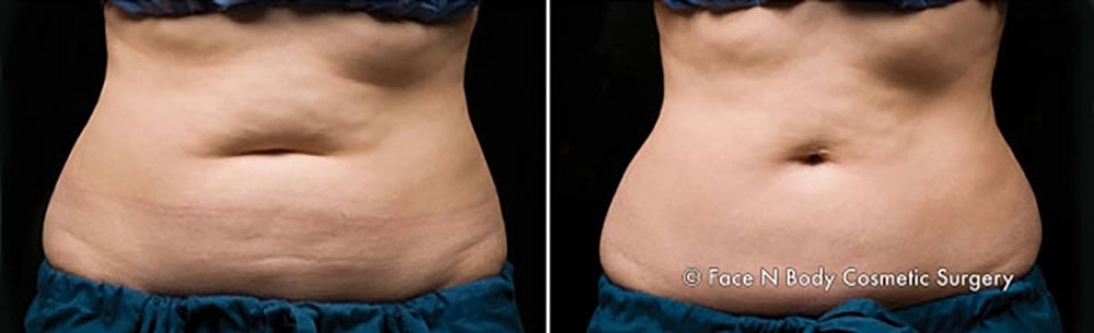 Coolsculpting Before & After
