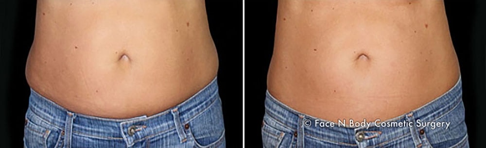 Coolsculpting Before & After