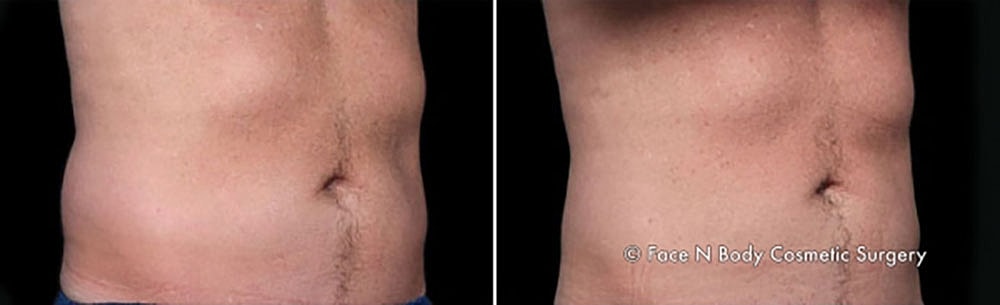 Coolsculpting Before & After