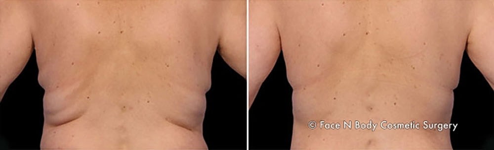 Coolsculpting Before & After