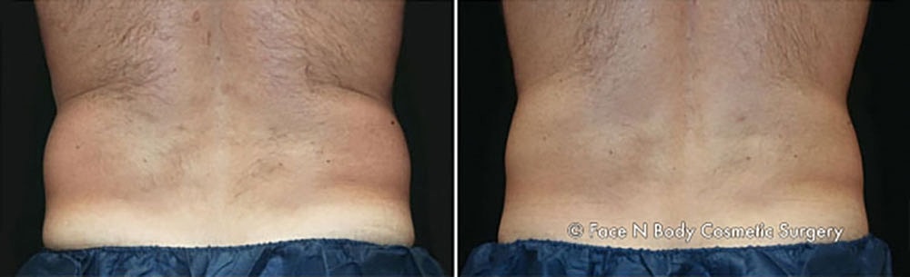Coolsculpting Before & After