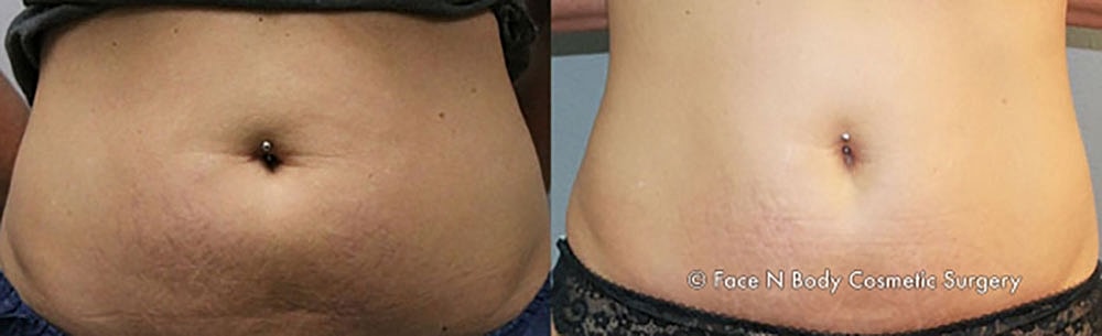 Coolsculpting Before & After