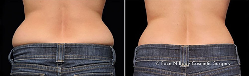 Coolsculpting Before & After